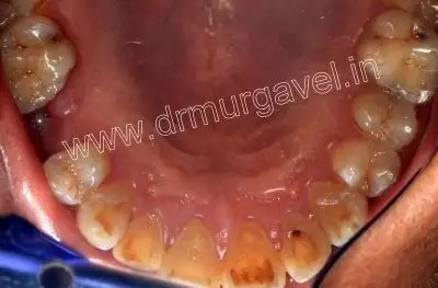 teeth replacement in india 