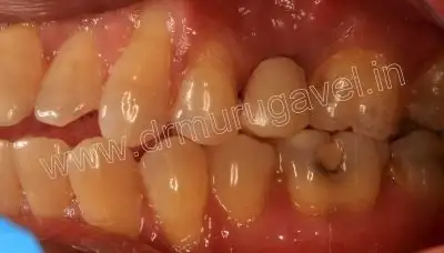 teeth replacement with implants 