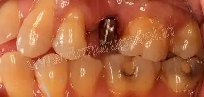 teeth replacement with implant 