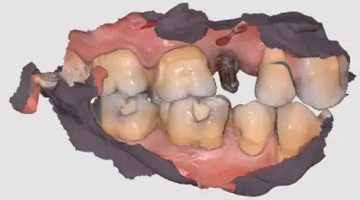 teeth replacement with implants 