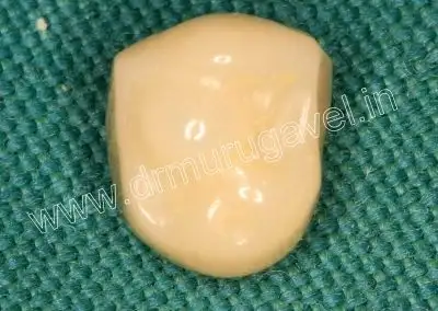 teeth replacement with dental implants 