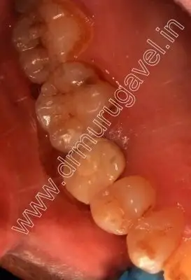 teeth replacement with dental implants 