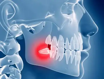 wisdom tooth