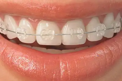 ceramic braces