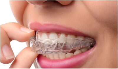 clear aligners 