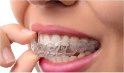 clear aligners