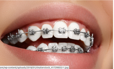 metal braces 