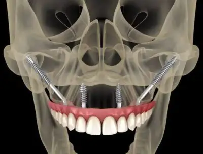 Zygoma implants