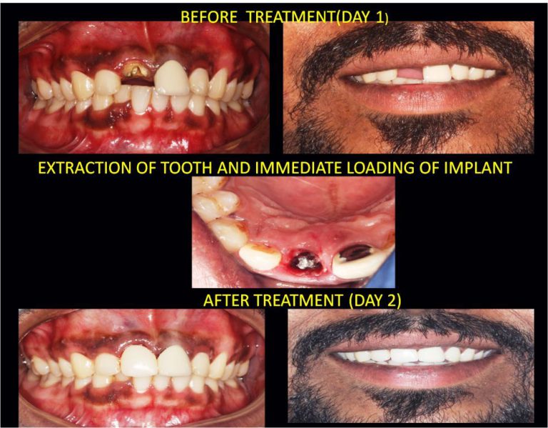 Immediate Dental Implant