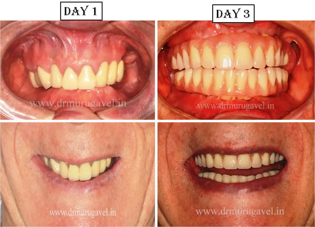 Full Mouth Dental Implants in 3 Days