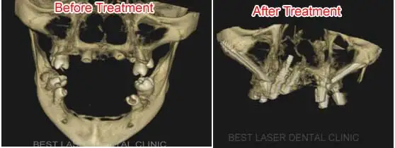 Zygomatic Dental Implants