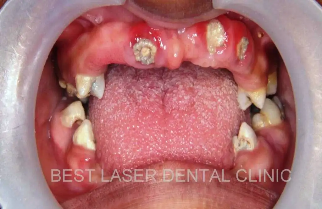 Zygomatic Dental Implants