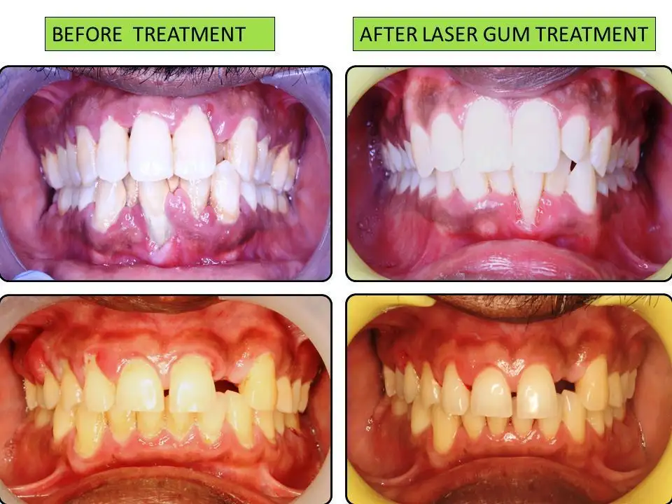 Laser Gum Treatment (LANAP)