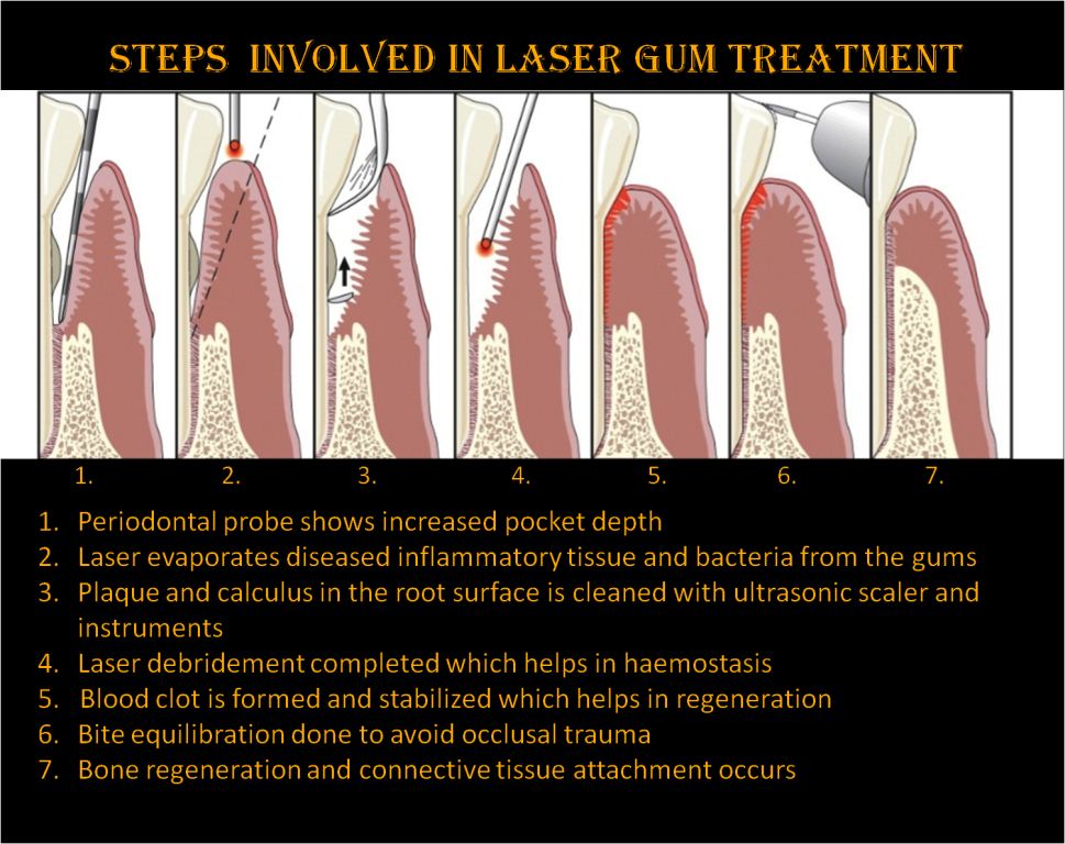 Laser Gum Treatment (LANAP)