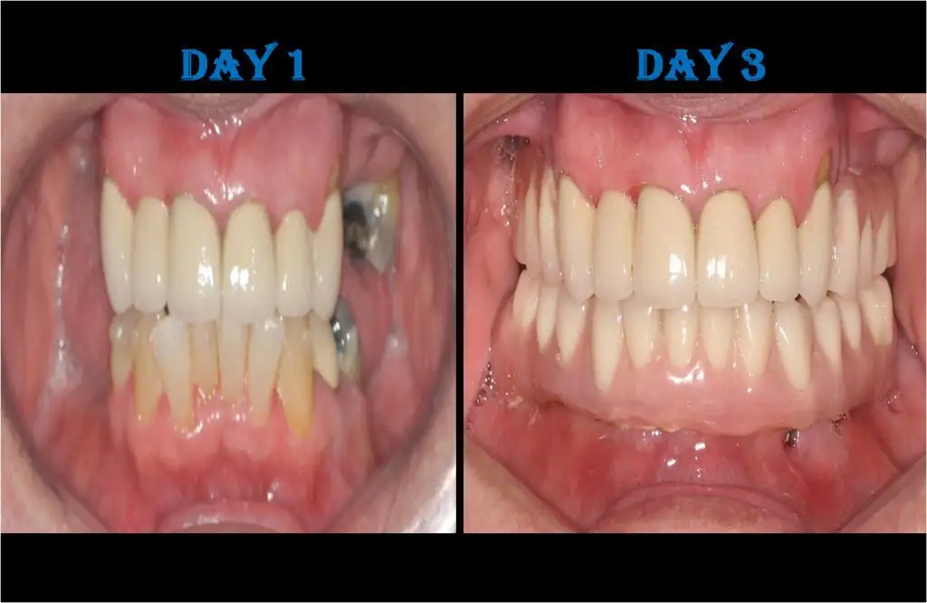 LOWER FULL ARCH REPLACEMENT