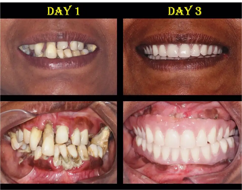 fixed New Teeth in 3 Days - Dental Implants