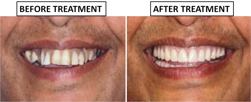 Full Mouth Dental Implants in 3 Days