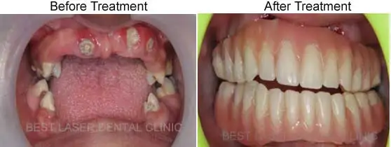 Zygomatic Dental Implants