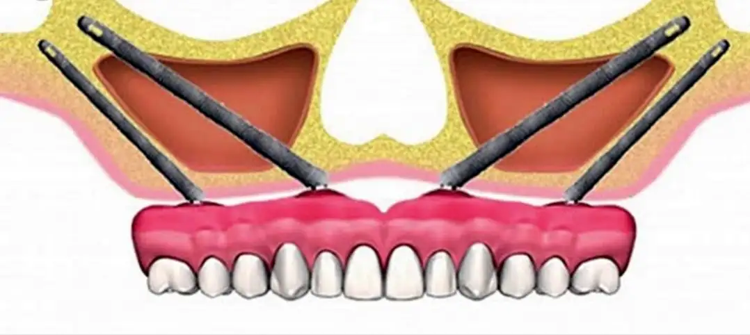 Zygomatic Dental Implants