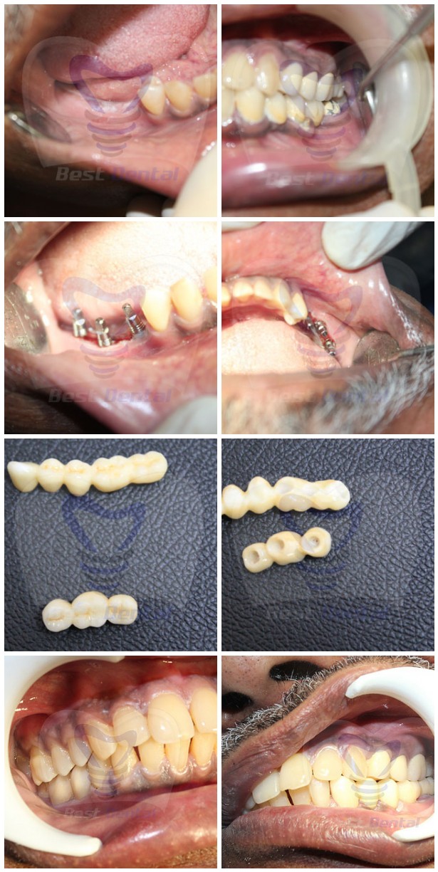lower jaw dental implant replacement