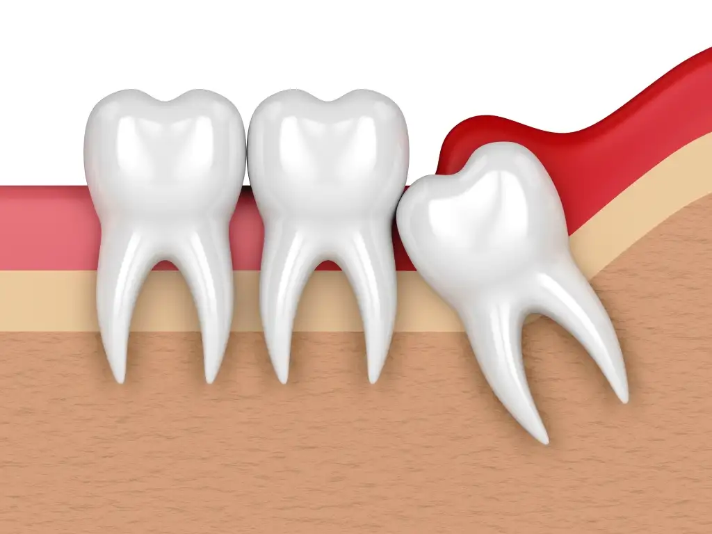 WISDOM TOOTH REMOVAL