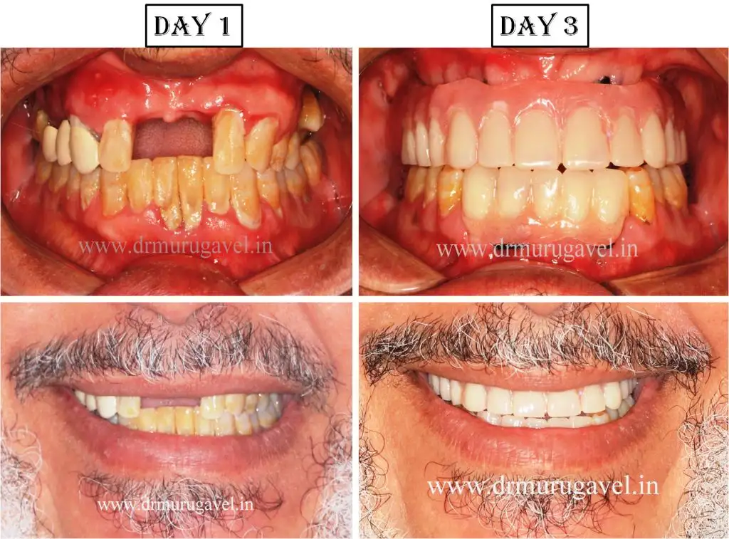 Full Mouth Dental Implants in 3 Days
