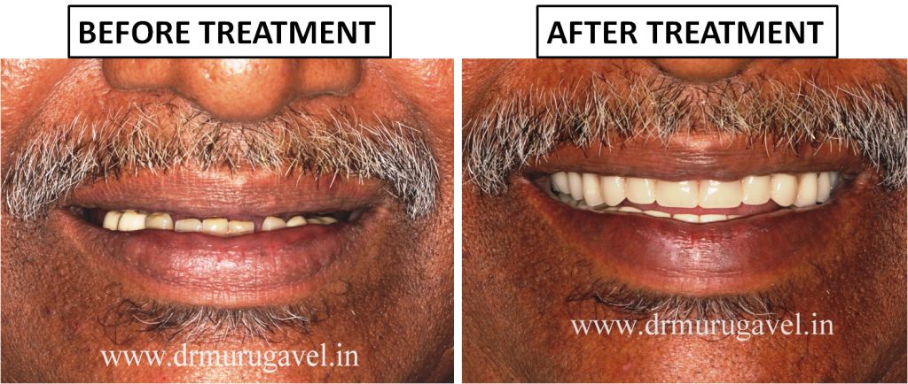 Full Mouth Dental Implants in 3 Days