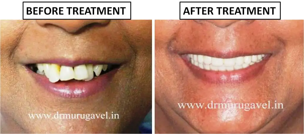 Full Mouth Dental Implants in 3 Days