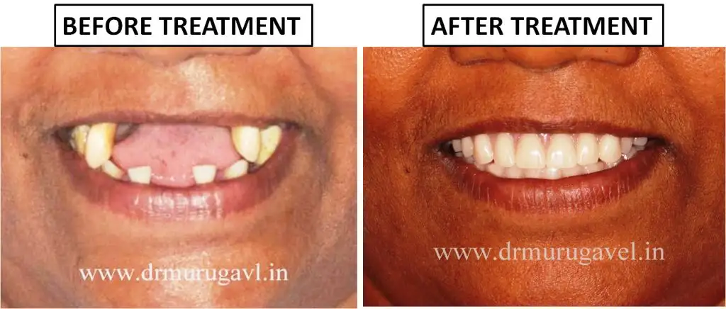 Full Mouth Dental Implants in 3 Days