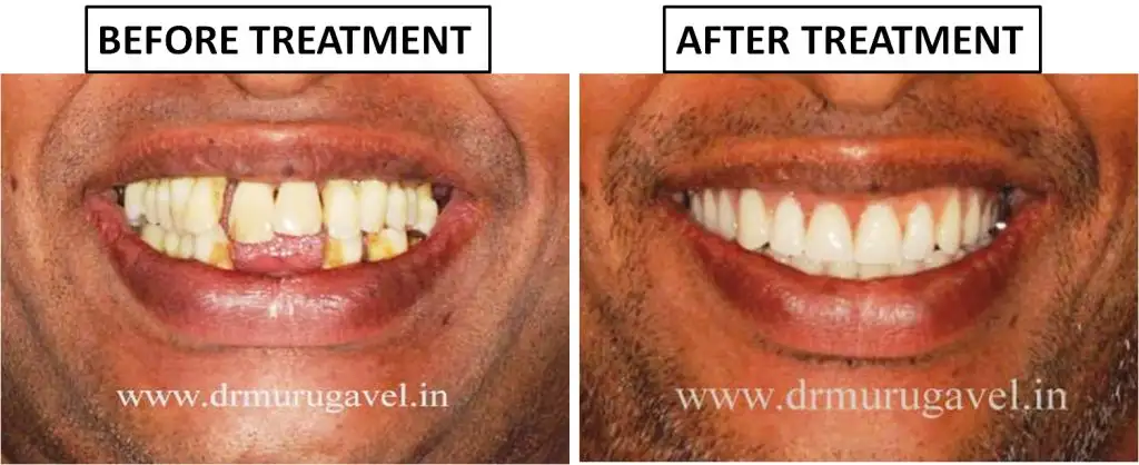 Full Mouth Dental Implants in 3 Days