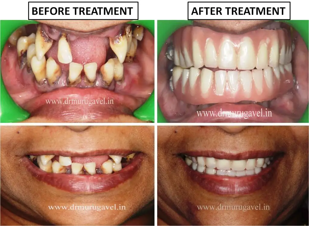 Full Mouth Dental Implants in 3 Days