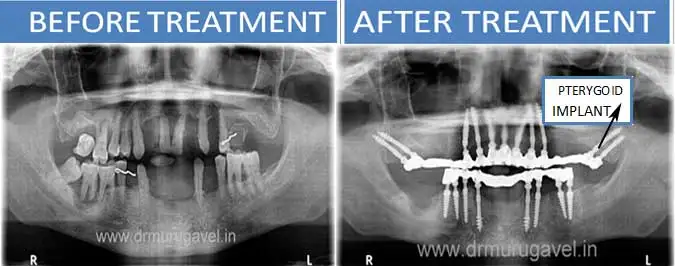 PTERYGOID IMPLANTS