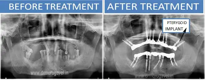 PTERYGOID IMPLANTS