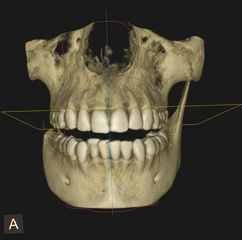 CBCT