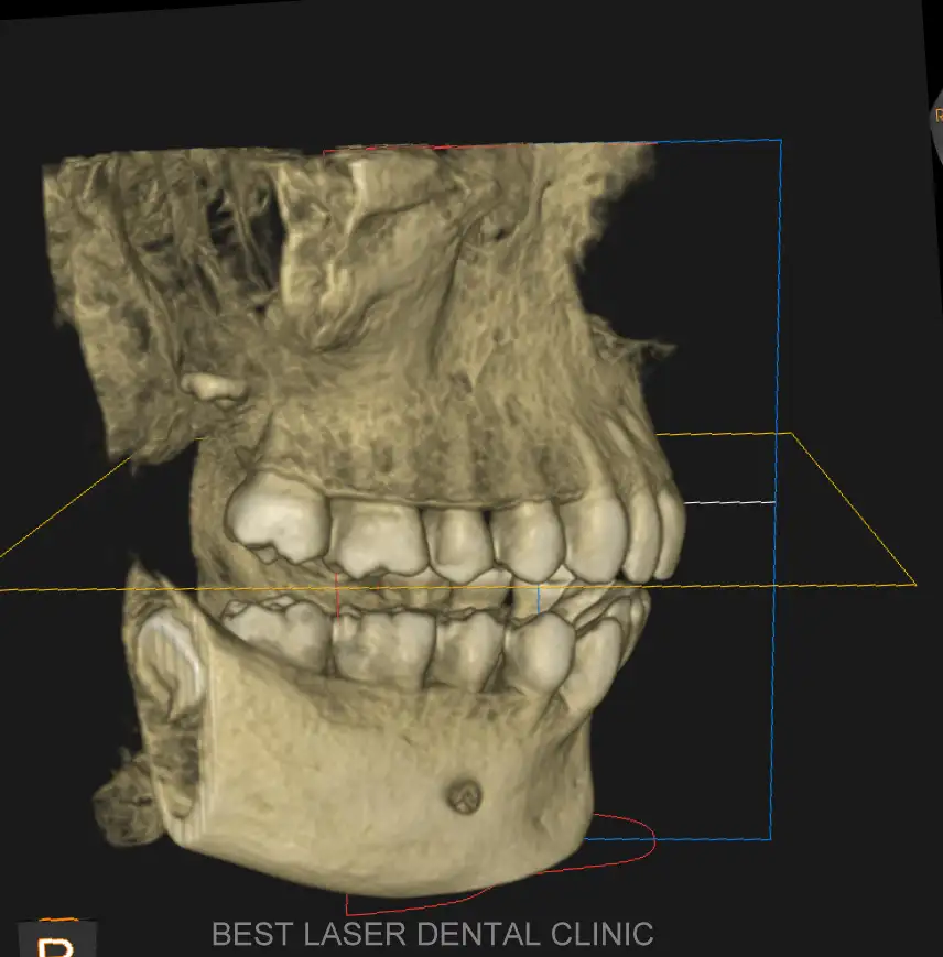 CBCT