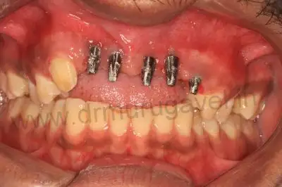 Implants in front teeth 