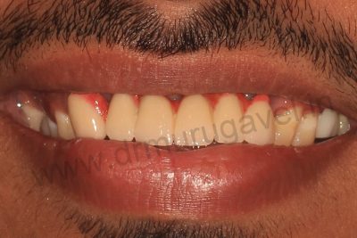 Front teeth replacement with Implants 