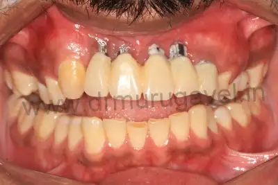 Front teeth replacement with Implants 