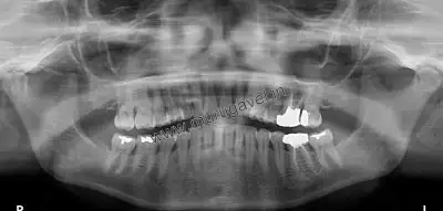 Teeth replacement with digital dentistry in India