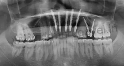 Dental implants in x ray