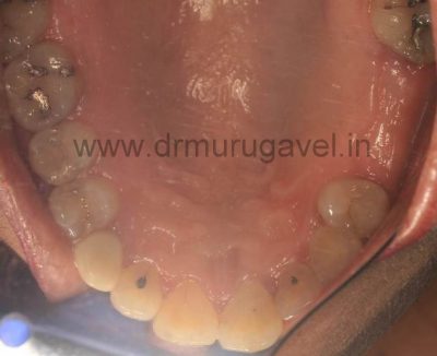Best Dental Clinic for Teeth Replacement In India