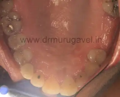 Best Dental Clinic for Teeth Replacement In India