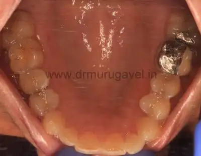 Teeth Replacement with Digital dentistry