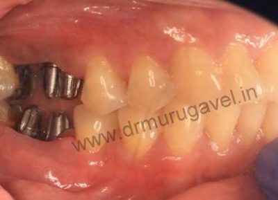 Teeth replacement with Digital dentistry 