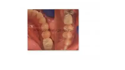 Teeth replacement with digital dentistry in India