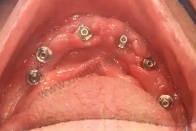 All on 6 implants 