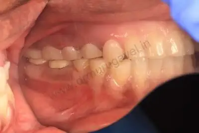 zirconia implant