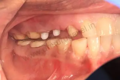 zirconia implant india