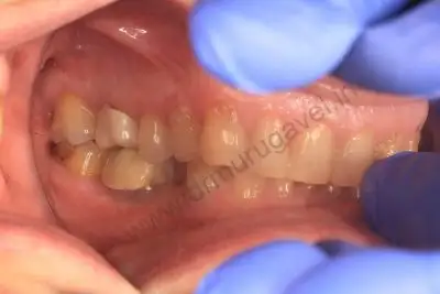 zirconia implants in india 