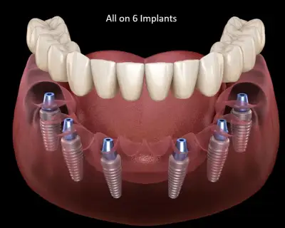 Nobel biocare all on 6 implants 